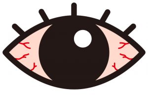 治らない目の充血の原因と対処法を解説する記事のアイキャッチ画像