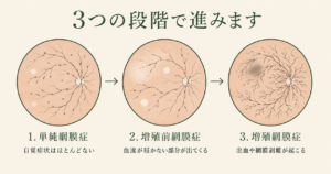 単純網膜症・増殖前網膜症・増殖網膜症という糖尿病網膜症の3つの進行段階を、眼底の様子とあわせて示した図