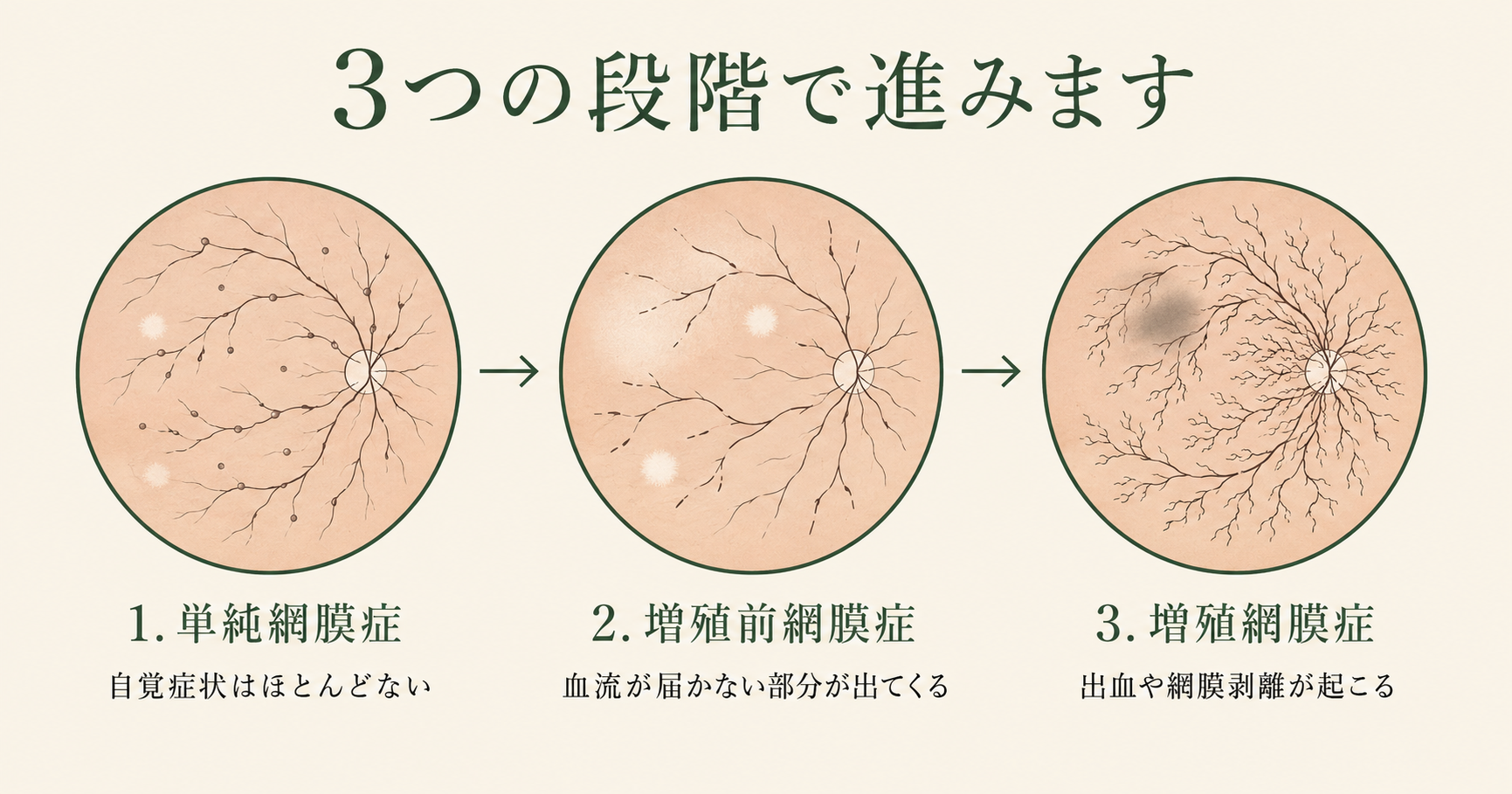 糖尿病網膜症とは｜症状・原因・進行段階と失明を防ぐ予防策を薬剤師が解説