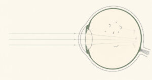 硝子体の濁りが網膜に影を落とす様子を示した眼球の断面図
