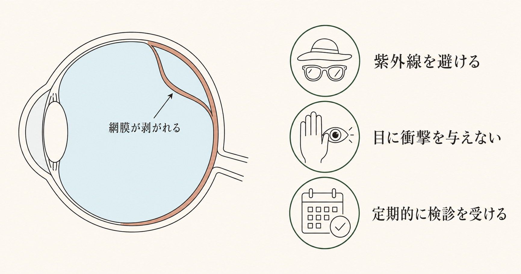 あなたも発症するかもしれない網膜剥離！その予防法とは？