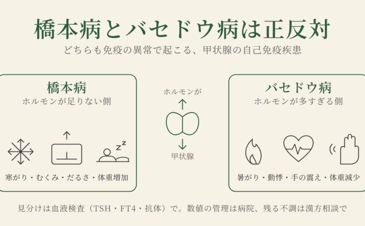 橋本病とバセドウ病は正反対：橋本病はホルモンが足りない側、バセドウ病は多すぎる側（図解）