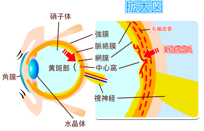 加齢黄斑変性 症状とは？予防とホームケア - 漢方薬局 葵堂【全国対応】